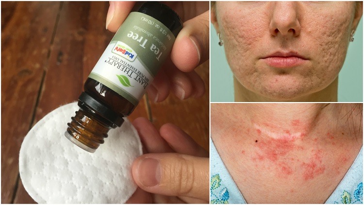 10 Reasons To Put Tea Tree Oil On Your Skin: Beat Acne, Eczema & More